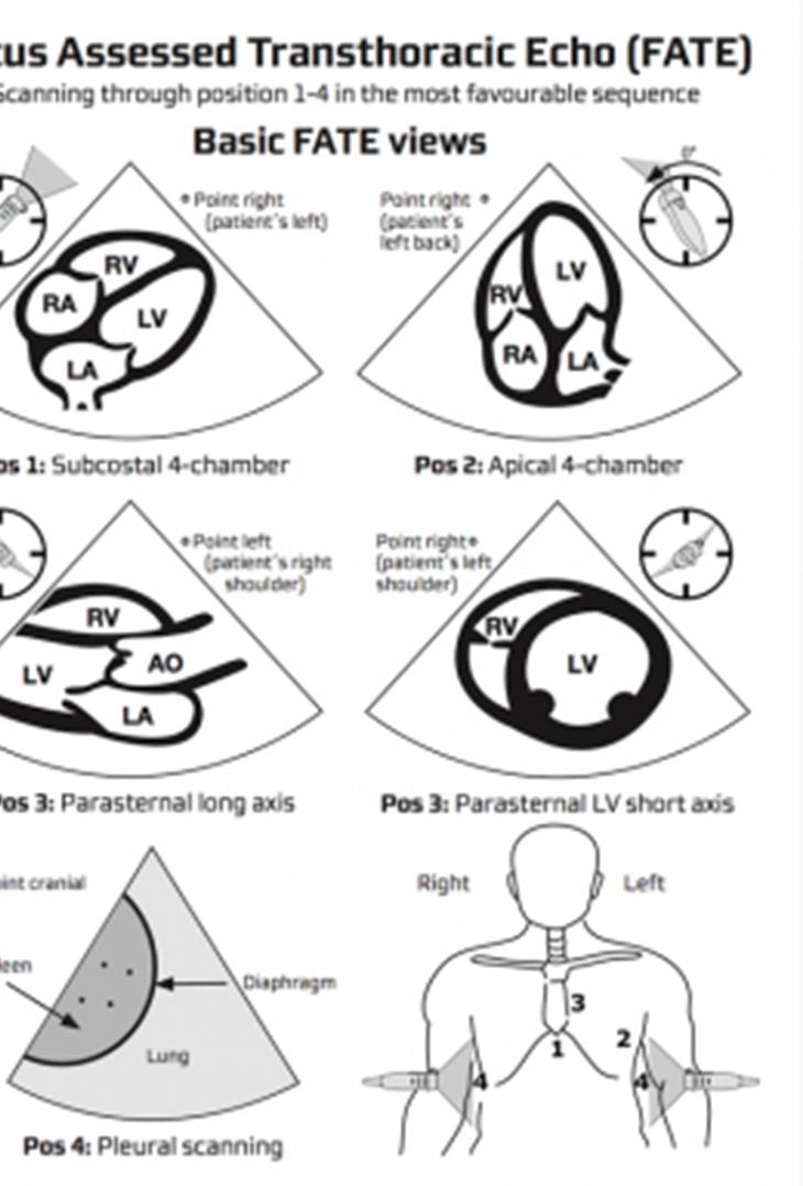 FATE schemat oceny schemat ABCDEF: A aorta B both ventricles C contractility