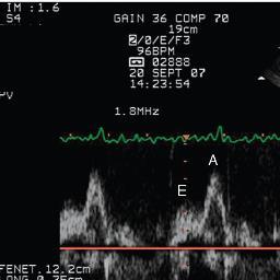 Papanikolaou J, Makris D, Saranteas T, et al.: New insights into weaning from mechanical ventilation.