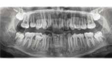 żuchwa -zgryzowe S1 jaw cavities S2