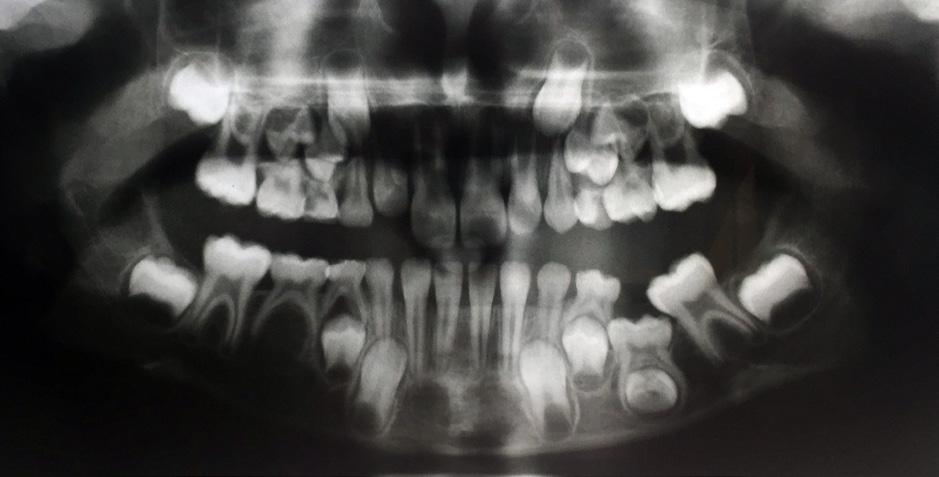 CLINICAL ORTHODONTICS 2/2018 2 3a 3b Ryc. 2. Wyjściowe zdjęcie pantomograficzne.