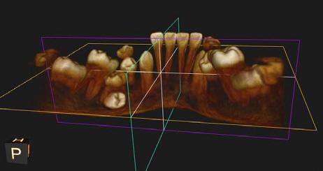 Tomografia komputerowa CBCT po około 2 latach od pierwszej wizyty, nadal z