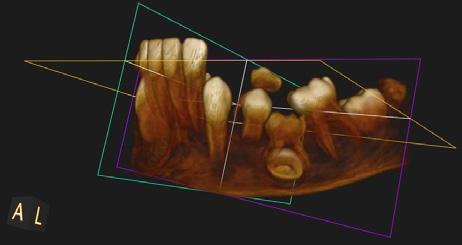 Reinclusion of tooth 75, the germ of permanent tooth 35 is present Fig.