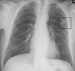 Rak płuca Główna przyczyna zgonów z powodu nowotworów złośliwych Na Dolnym Śląsku
