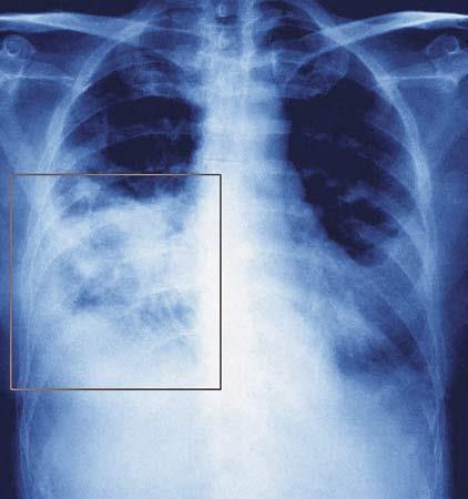 Cele fizjoterapii pooperacyjnej Zapobieganie płucnym