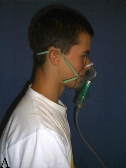 Rodzaje inhalatorów A