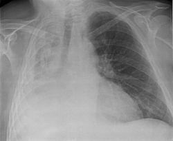 Ryzyko pooperacyjnych powikłań po leczeniu raka płuca Istotna korelacja niskiej wydolności fizycznej < 50 60% należnych wartości VO 2max