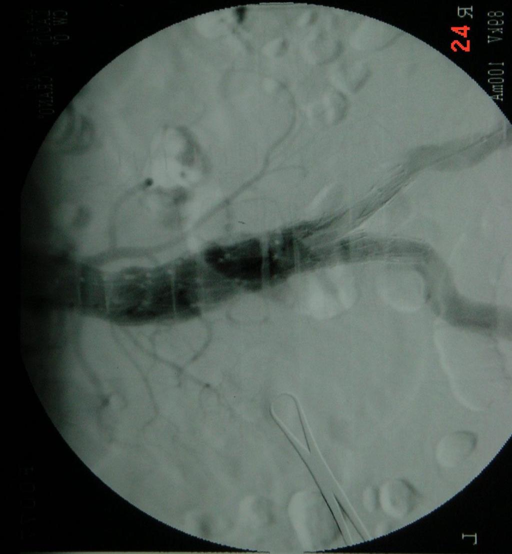 Tętniak aorty brzusznej-aaa TĘTNIAK AORTY BRZUSZNEJ: utrzymujące się w czasie rozszerzenie osłabionej ściany naczynia o wieloczynnikowej patogenezie.