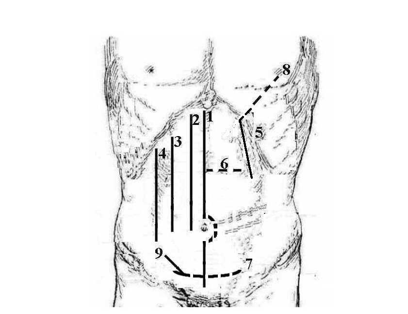 Klasyczne linie cięć dla dostępu do narządów jamy brzusznej 1 pośrodkowe w linii środkowej ciała, pomiędzy mięśniami prostymi brzucha 2 przyśrodkowe nad brzegiem przyśrodkowym mięśnia prostego