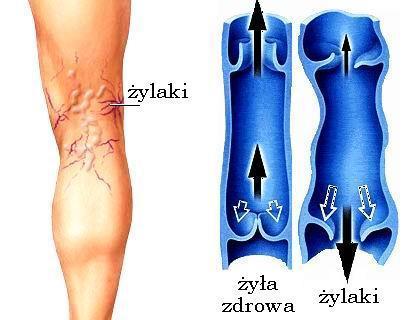 Choroby układu żylnego Choroby układu żylnego w kończynach dolnych prowadzą do zaburzeń odpływu krwi Na hemodynamikę odpływu krwi z kończyn wpływa wydolność zastawek