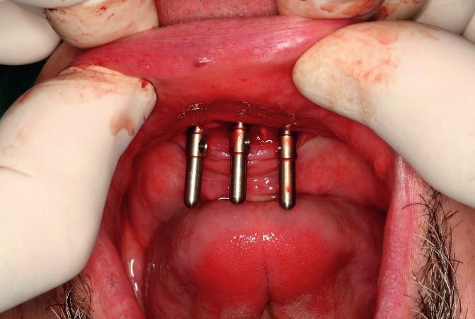 distorted the facial aesthetics (Fig. 1). Extraorally, apart żuchwy z wąską strefą neutralną z zastosowaniem mostu protetycznego i protezy ruchomej.