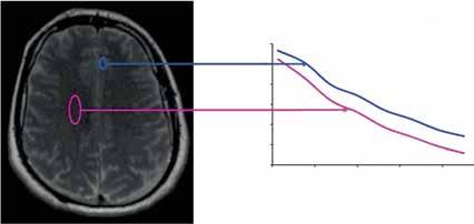 11 Krzywe relaksacji T2 przedstawione dla istoty szarej i białej, na podstawie prostego doświadczalnego protokołu uzyskanego na MR. mózgu.