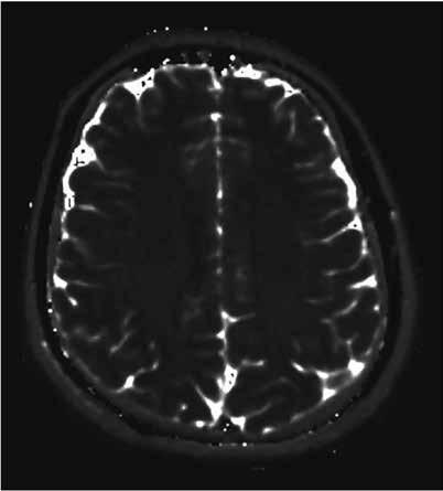 pojęcie relaksacji w obrazowaniu mr 41 Rycina 3.12 Obliczona doświadczalnie mapa T2 mózgu.