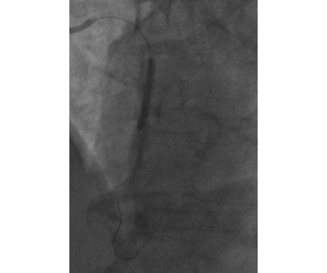 Rycina 4A. LTW przed implantacją stentu Rycina 4B. LTW pozycja stentu 3,0 28 mm https://journals.viamedica.pl/kardiologia_inwazyjna Rycina 4C. Moment rozprężenia stentu Rycina 4D.