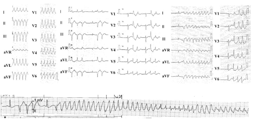 Yoshihisa Enjoji i wsp., Ablacja włókien układu Purkinjego wywołujących migotanie komór Rycina 1. Górny lewy panel: 12-odprowadzeniowe EKG wykonane podczas przyjęcia chorego do szpitala.