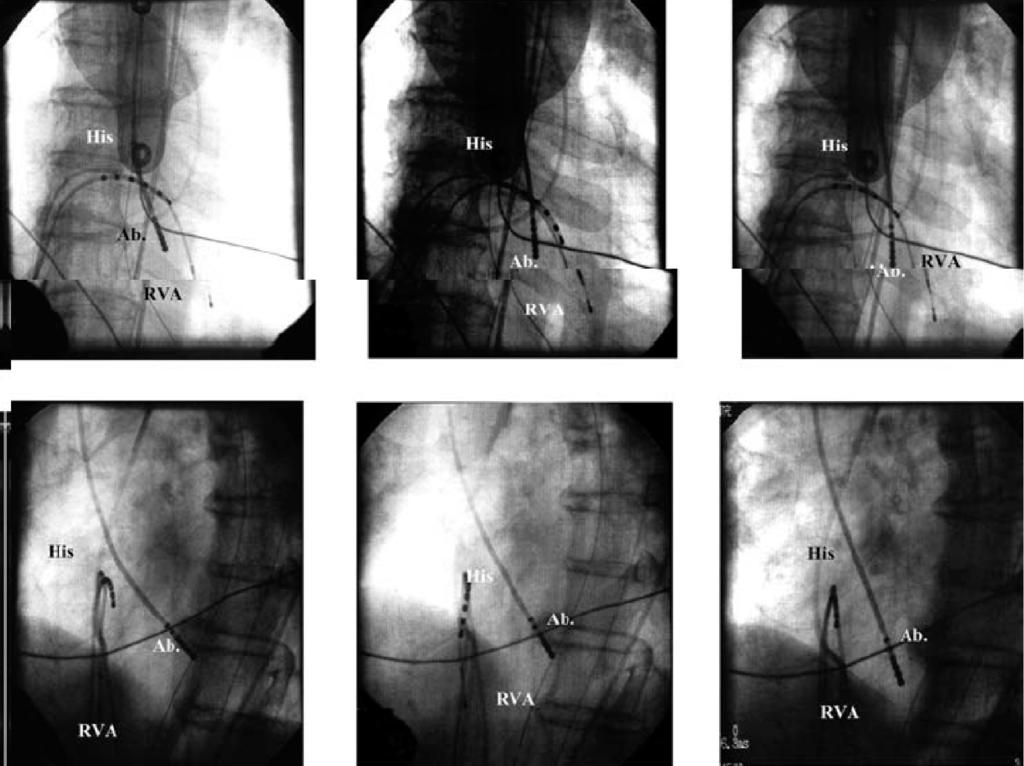 Folia Cardiologica Excerpta 2006, tom 1, nr 9 Rycina 2. Wewnątrzsercowy elektrokardiogram rejestrowany w miejscu skutecznej ablacji. Aplikacja prądu o wysokiej częstotliwości wykonana w 3 miejscach.