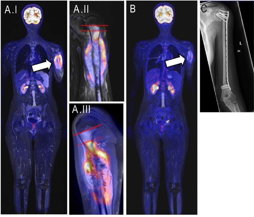 17-letnia pacjentka z osteoblastic osteosarcoma, ocena