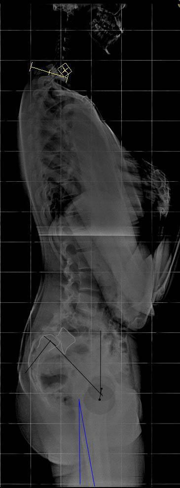 Hypolordoza L + Hypokifoza Th Hypokyphosis Hypolordosis