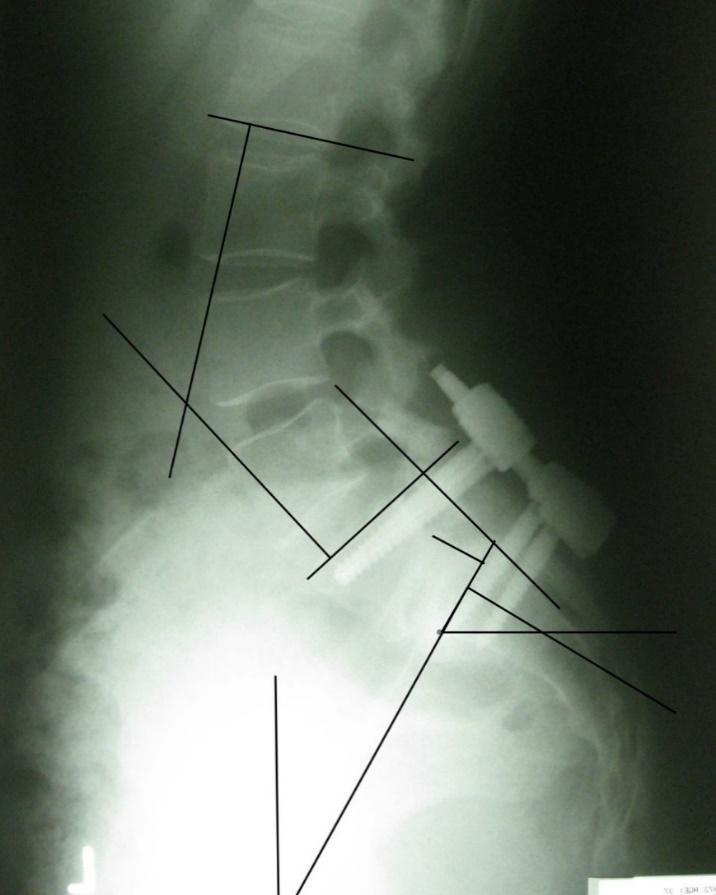 reduction in PT regardless patients