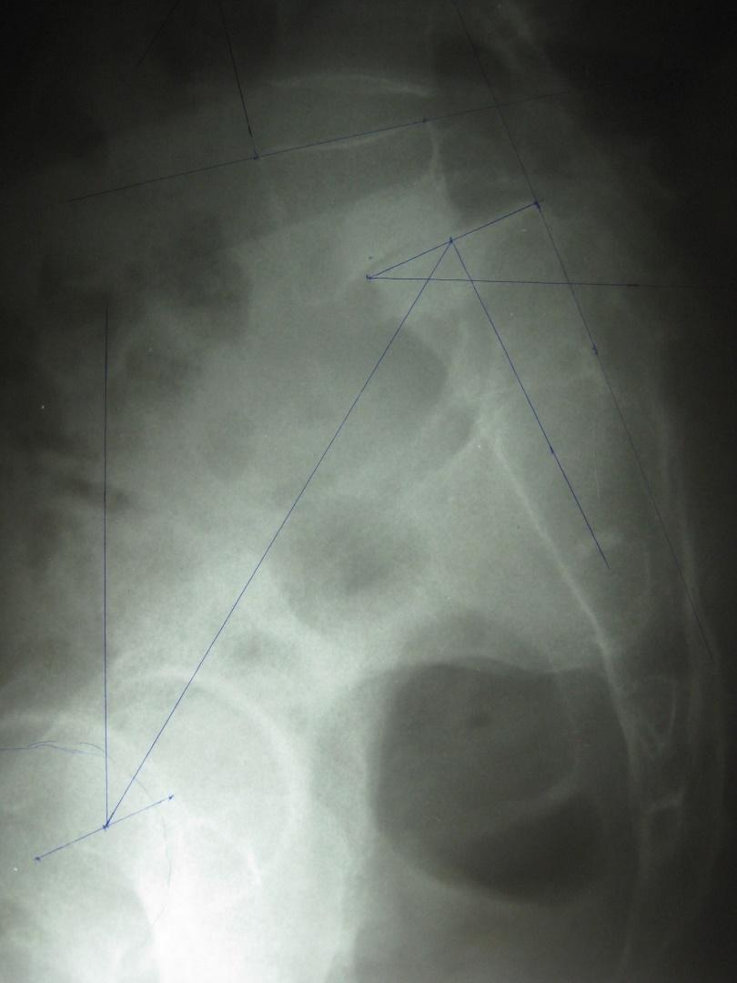 o reduction in PT regardless