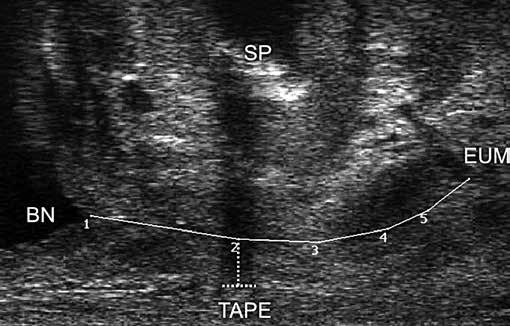 de novo urgency concomitant with permanent urine leakage developed shortly after the surgery. Forty-nine (80.3%) women were initially treated with a transobturator sling and 12 (19.