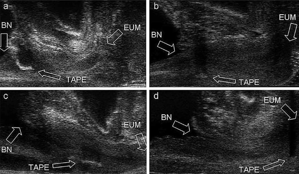 Figure 2. Different positions of the tapes in patients with suburethral sling failure. a) The tape located close to the bladder neck (BN), below the 25% of the urethral length.