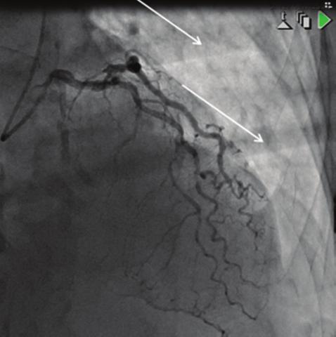 angiografii/angioplastyki w trakcie RKO z użyciem urządzenia LUCAS Delikatne