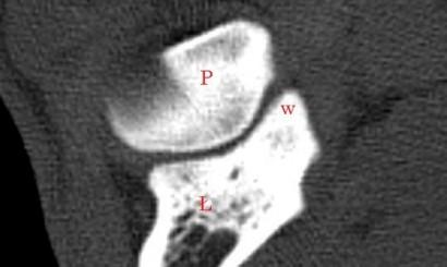 Radiologiczna ocena dysplazji stawów łokciowych u psów 13 uszkodzeniu chrząstki stawowej kłykcia przyśrodkowego poprzez przemieszczony fragment wyrostka wieńcowego przyśrodkowego i co za tym idzie