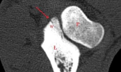 Jednoznaczne odróżnienie OCD od kissing lesion zapewnia artroskopia [7]; udaje się to także za pomocą tomografii komputerowej [9].