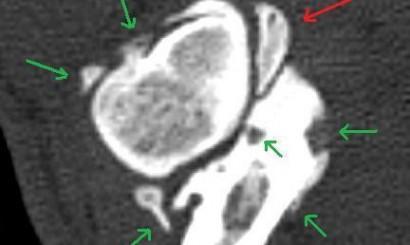 Radiologiczna ocena dysplazji stawów łokciowych u psów 15 co może wskazywać na patologię chrząstki stawowej, która w