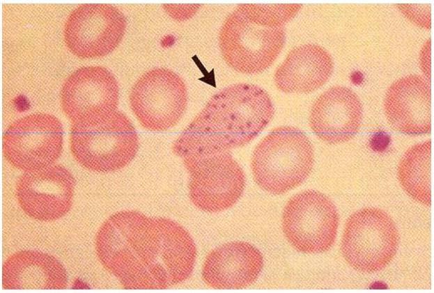 erytrocytów (krwinki tarczowate i nakrapianie bazofilowe),