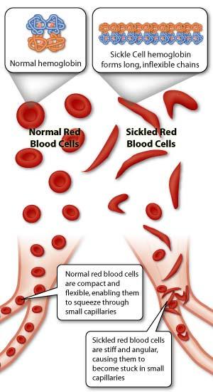 Obraz kliniczny Wrodzona anemia z poziomem Hb 6 9 g/dl, Przełomy wenookluzyjne wywołane infekcjami, odwodnieniem, zakwaszeniem, zimnem, niedotlenieniem, Przełomy spowodowane sekwestracją trzewną