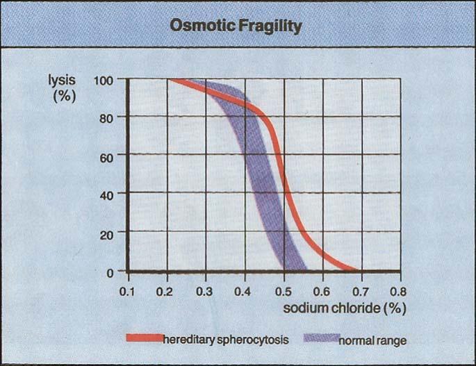 Ujemny odczyn Coombsa, Obecność sferocytów w rozmazie, Zmniejszona oporność osmotyczna