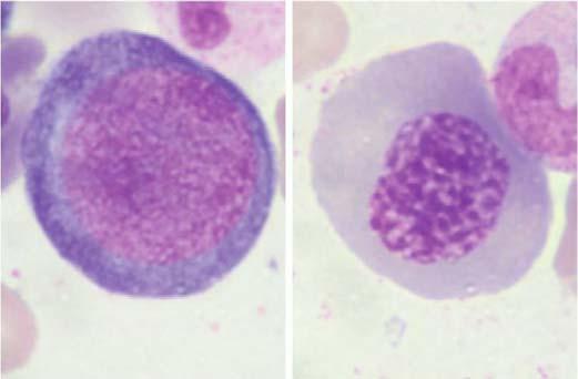 Odchylenia laboratoryjne Niedokrwistość makrocytowa (MCV > 98 fl), Obniżona retikulocytoza,