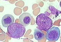 Odchylenia laboratoryjne Niedokrwistość makrocytowa (MCV > 98 fl), Obniżona retikulocytoza, Megaloblastyczny obraz szpiku,