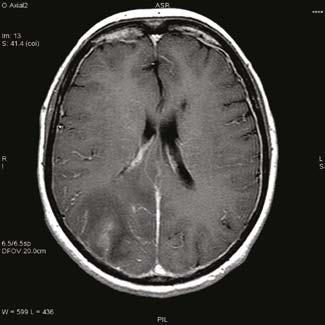 Poorly defined cortical subcortical ischemic region with discreet hemorrhagic chan ges and single, fresh extravasation located In frontal lobes white matter (in the long axis does not exceed 15 mm)