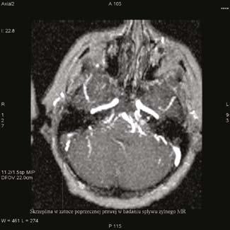 3b) Figure 3a. Contrast exhanced MR (SE, T1 weighted, ax.) revealed loss of enhancement persisting in the external part of the right transvers sinus indicating reasorbing thrombus.