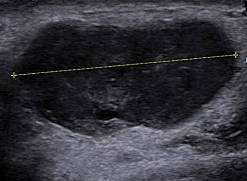 trybie B-mode, a w szczególności sonoelastografia (funkcja VTIQ) to ważne metody diagnostyki różnicowej.