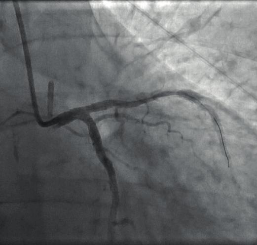 E F Rycina 3 A - Koronarografia lewej tętnicy wieńcowej (istotne zwężenie GLTW/GPZ/GO strzałka).