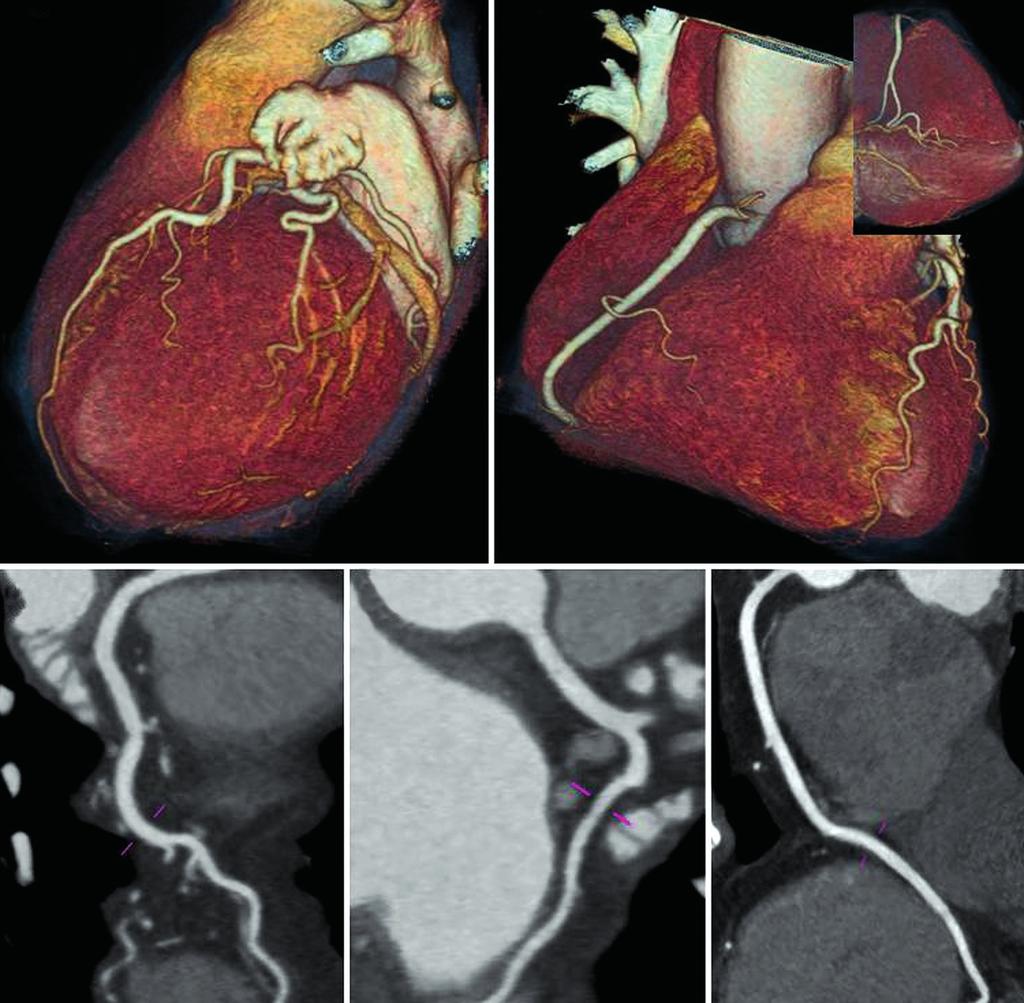 A C B D E Ryc. 3. Tomografia komputerowa tętnic wieńcowych. Rekonstrukcje objętościowe (VRT) lewej tętnicy wieńcowej (A) oraz prawej tętnicy wieńcowej (B).