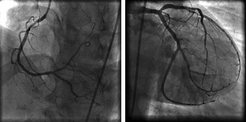 Dwa stenty metalowe (BMS, bare metal stent) zaimplantowane do prawej tętnicy wieńcowej (RCA, right coronary artery), przepływ TIMI równy 3; B.