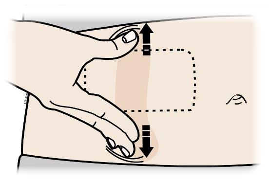 Nie wolno dotykać przycisku uruchamiającego zanim załadowany automatyczny mini-dozownik nie zostanie przymocowany do skóry.