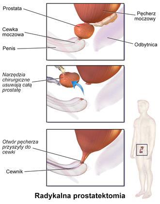 Leczenie raka prostaty zależy od Stopnia zaawansowania choroby Ocenionej kategorii ryzyka