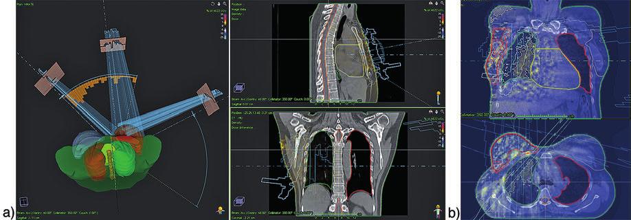 radioterapia \ radiotherapy artykuł naukowy \ scientific paper Fot.