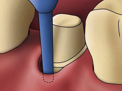 Łatwa retrakcja dzięki idealnej kapsułce retrakcyjnej Już ponad 45 lat 3M TM ESPE TM wskazuje drogę w dziedzinie wycisków stomatologicznych.