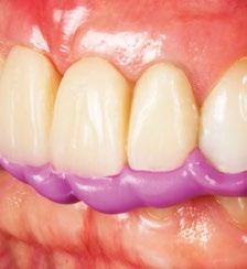 Materiał przeznaczony do ustalania maksymalnego zaguzkowania zębów, ustalania centralnego ułożenia żuchwy w stosunku do szczęki, równoczesnych wycisków szczęki i żuchwy.