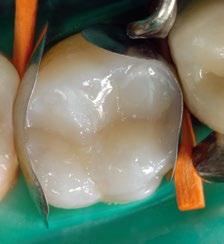 Zmack jest przeznaczony do wypełniania ubytków w zębach przednich i bocznych, polecany w szczególności do bezpośredniego uzupełniania wszystkich klas ubytków próchnicowych oraz ubytków pochodzenia