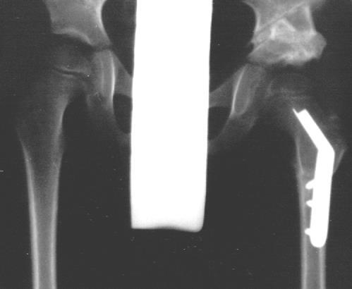Osteotomia wg