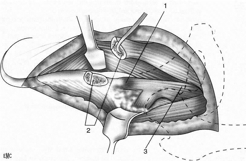 2. KROK Osteotomia SIAS Caput