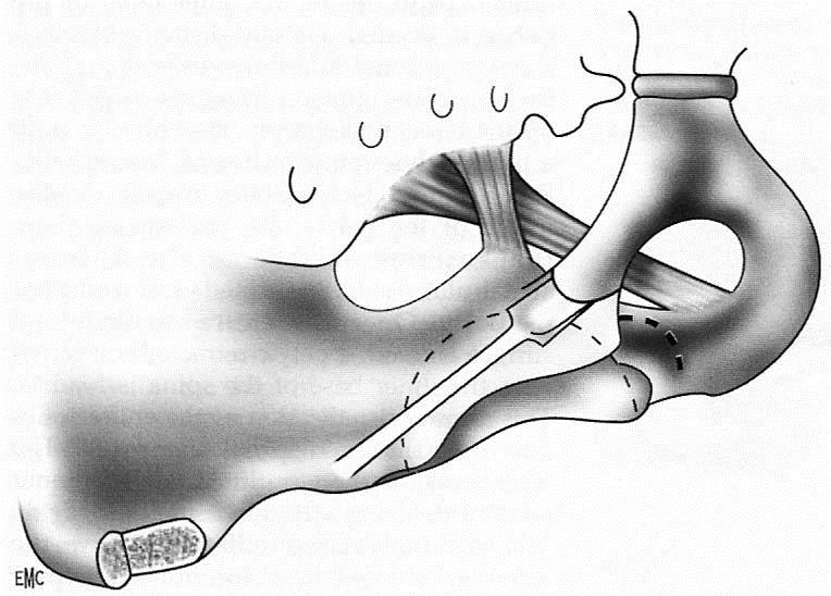 5. KROK Osteotomia