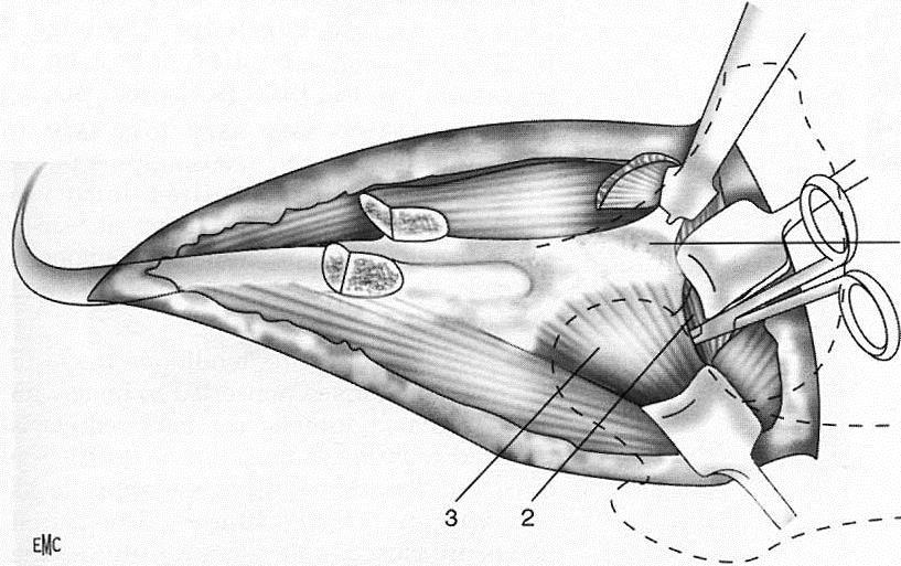 6. KROK Osteotomia kości kulszowej Capsula articularis Tendo M.